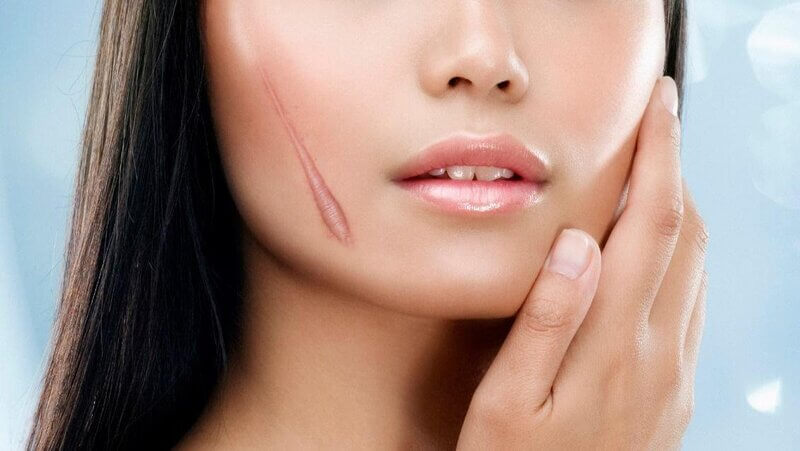 Mẹo chữa sẹo lồi dân gian đơn giản hiệu quả áp dụng tại nhà