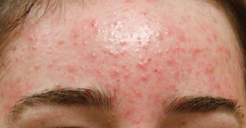 Mụn trên trán là bị gì? Nguyên nhân khiến mụn mọc trên trán?