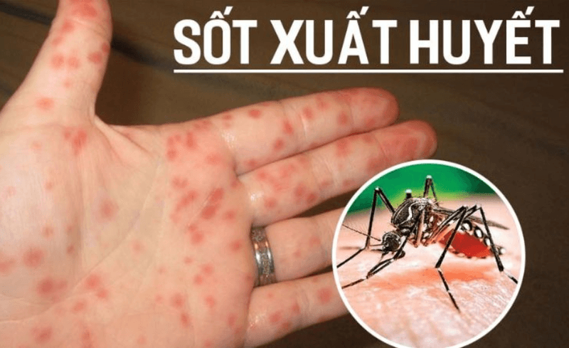 Sốt xuất huyết có lây không? Phòng tránh sốt xuất huyết